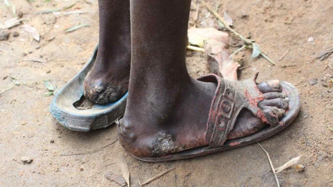 Jiggers