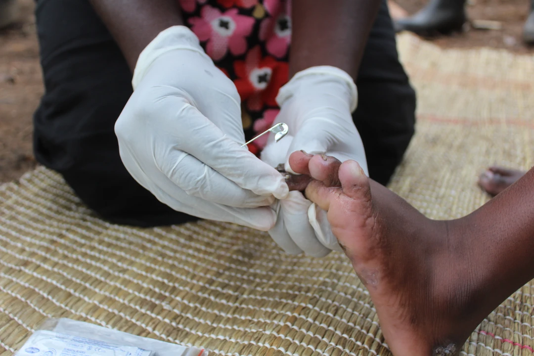 Nurse removing jiggers in Kasovu